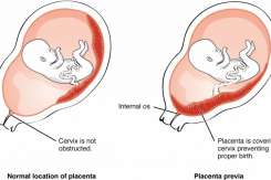 Sarcina joasă, adică placenta previa. Tot ce trebuie să știi!