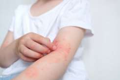 Dermatita atopică: mai mult decât o ”simplă afecțiune a pielii”