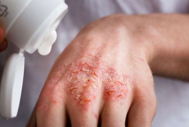 Eczema: cauze, simptome, prevenţie