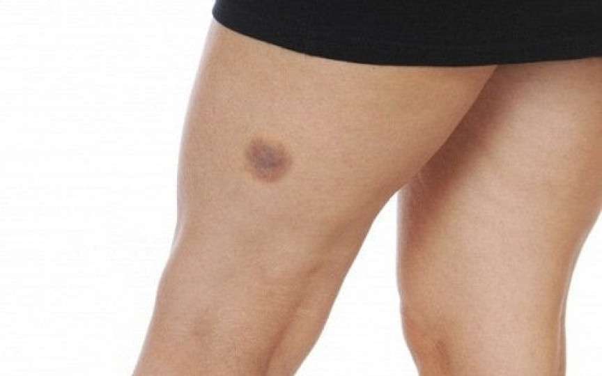 Pregătește-te pentru vară și scapă de vânătăi! Trucuri simple pentru vacanță