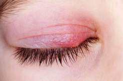 Cum se tratează ulciorul, infecția oculară care apare de la mic la mare