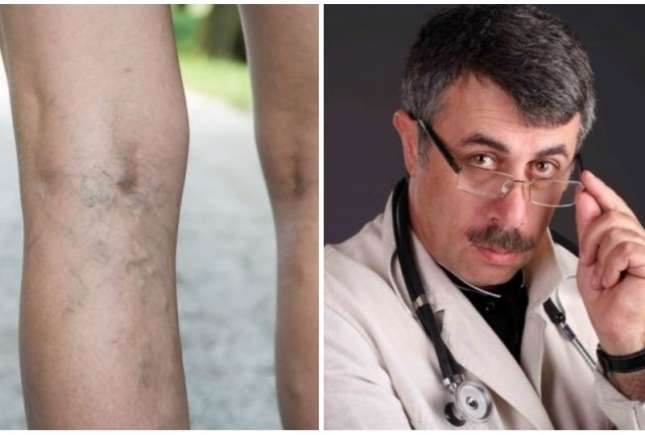 Evghenii Komarovskii are sfaturi și pentru sănătatea mamelor: profilaxia venelor varicoase