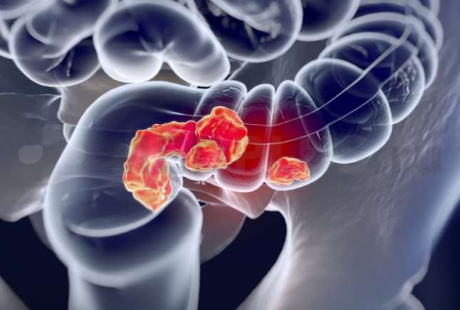 Patru semne principale ale cancerului de colon, dar pe care majoritatea oamenilor le ignoră