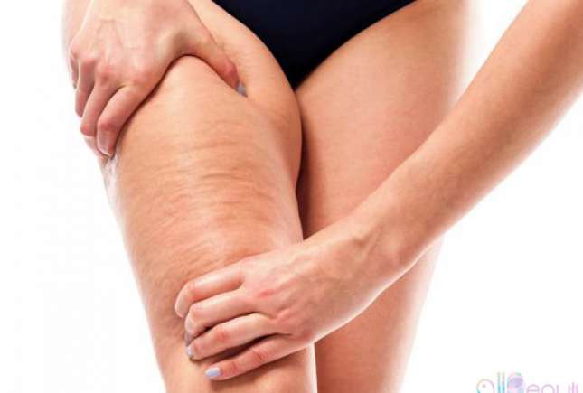 Celulită și vergeturi? Trucuri, dietă și exerciții care le combat