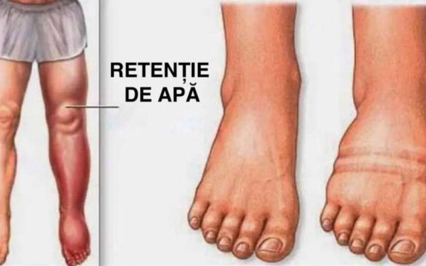 7 Alimente și băuturi care te pot scăpa de retenția de apă
