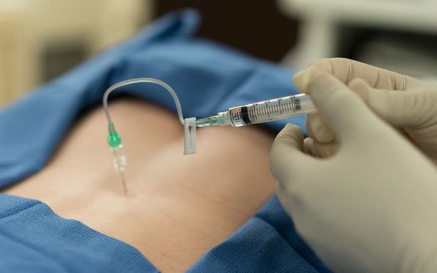 Anestezia epidurală vs. anestezia spinală