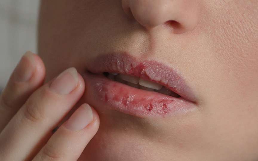 Ce probleme de sănătate poate semnala pielea uscată a buzelor