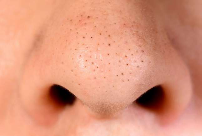 Tratament natural pentru punctele negre: exfoliant DIY cu ingrediente ieftine și eficiente