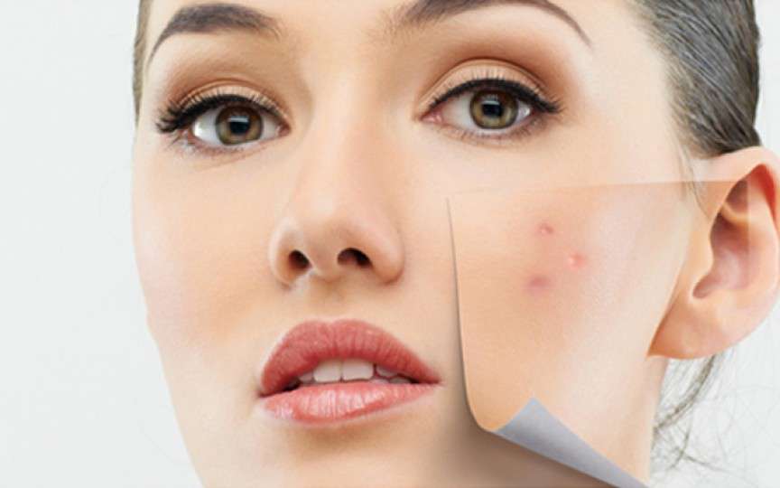 Consumul de lapte provoacă acnee? Ce spun specialiștii