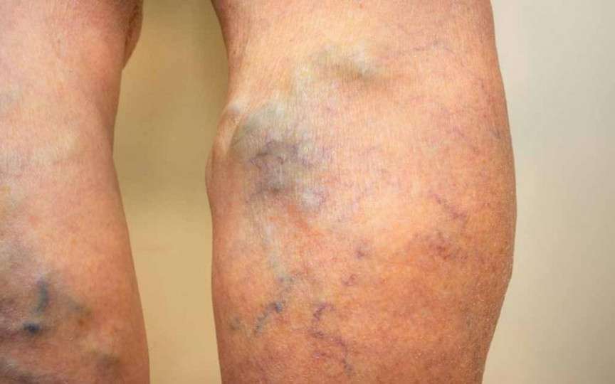 Suferi de varice? Iata 4 remedii naturale prin care poți trata acasă venele varicoase