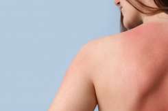 Arsuri solare? 5 ponturi să te refaci rapid
