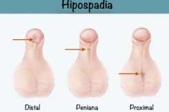 Medic chirurg pediatru despre copilul cu hipospadias și tratamentul chirurgical