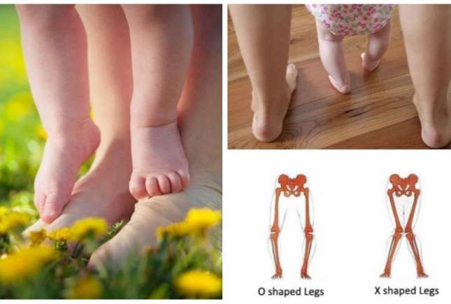 5 tulburări de mers la copii. Când trebuie să mergeți la specialist