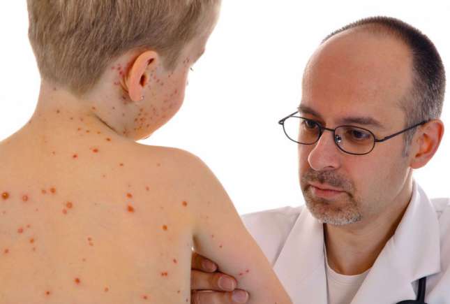 Alarmant!  71 de cazuri de rujeolă la Ceadîr-Lunga