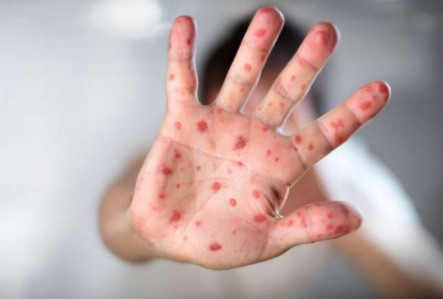 În Israel a murit de rujeolă o fetiță de 1,5 ani. Liderii religioși au făcut apel la părinți să-și vaccineze copiii
