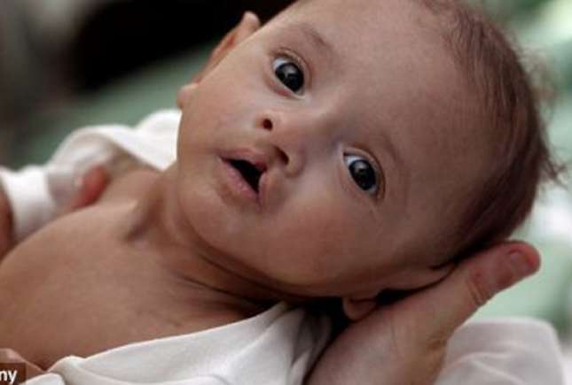 Medic primar geriatrie despre cheiloschizis (buza de iepure)