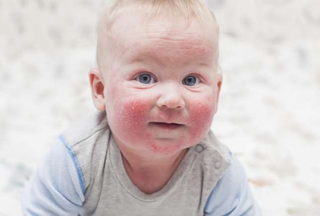Dermatita atopică: 8 întrebări și răspunsuri despre una dintre cele mai frecvente afecțiuni