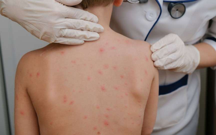 Pediatrul Mihai Craiu: Varicela nu este doar „niște bube pe corp”, ea poate produce leziuni cerebrale!