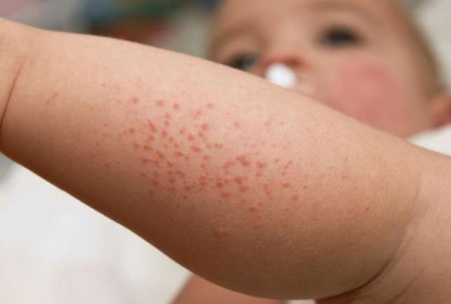 Medic pediatru-alergolog: Copilul poate avea un șoc anafilactic de la pește sau arahide chiar dacă nu le-a consumat