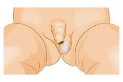 Testiculul necoborât – netratată la timp, afecțiunea poate duce la infertilitate și cancer