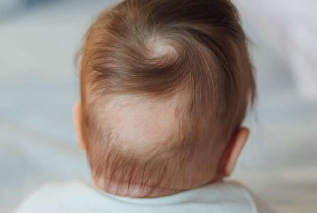 Cauzele căderii părului (alopecia), la bebeluși și copii