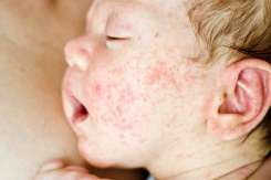 Complicațiile dermatitei atopice la copii și greșelile comise de părinți