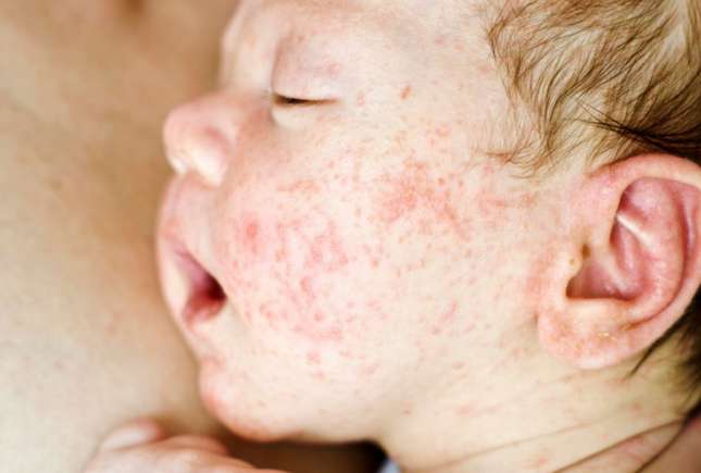 Complicațiile dermatitei atopice la copii și greșelile comise de părinți