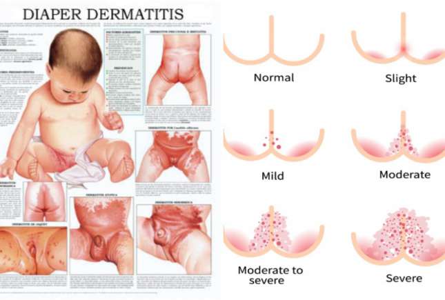 Dermatita de scutec, pe înțelesul părinților – sfaturi practice de la medic pediatru
