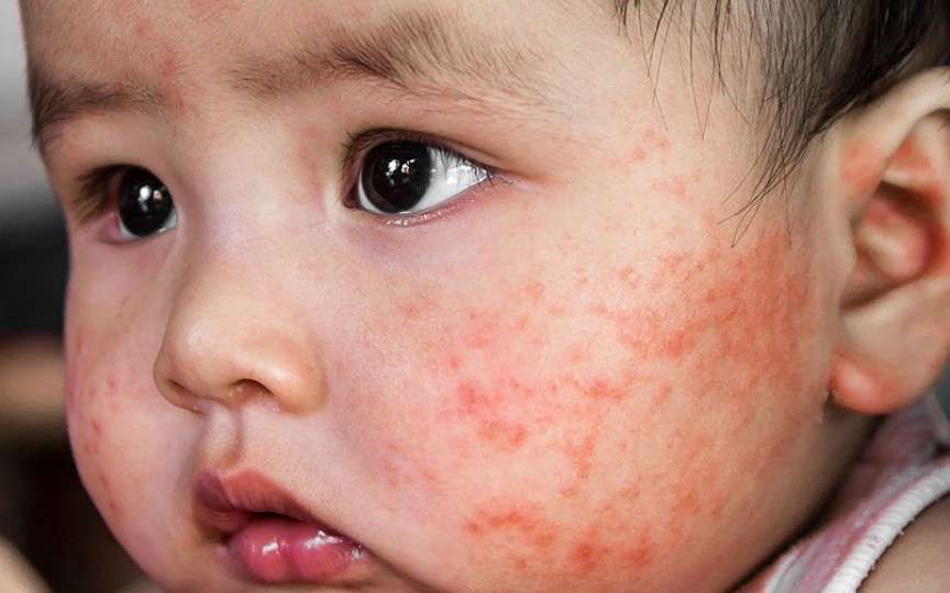 Medic: Dermatita atopică pornește de la curățenia exagerată. Cum se spală corect un bebeluș și hainele lui