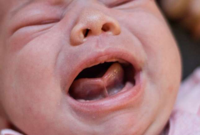 Medic geriatru despre frenul lingual scurt (limba scurtă) la bebeluși: Pot avea dificultăți în timpul hrănirii la sân
