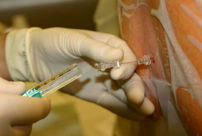 Anestezia epidurală: argumente pentru utilizarea acesteia