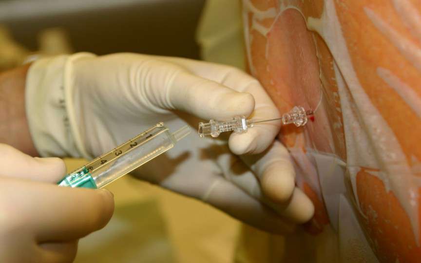 Anestezia epidurală: argumente pentru utilizarea acesteia