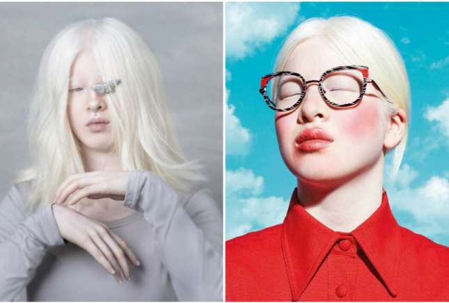 Istoria fetiței care a fost abandonată pentru că s-a născut cu albinism. Acum este un model de succes