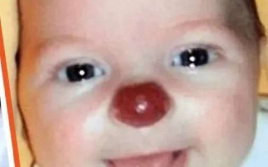 Fetița 'Rudolf', care a venit pe lume cu nasul roșu, a devenit o adolescentă superbă! Transformarea este uluitoare