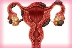 Endometrioza profundă - cauză de infertilitate