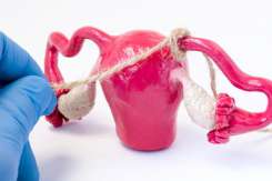 Medic ginecolog, despre legarea trompelor uterine
