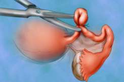 (VIDEO) Legarea trompelor uterine: cum se realizează și ce avantaje și dezavantaje are