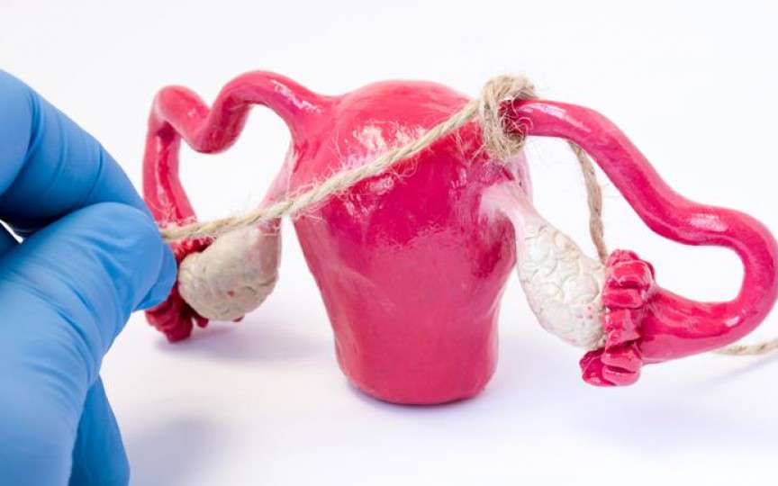 Medic ginecolog, despre legarea trompelor uterine