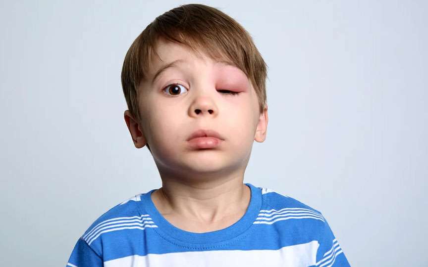 Edemul Quincke la copii: cauze, simptome și prevenție