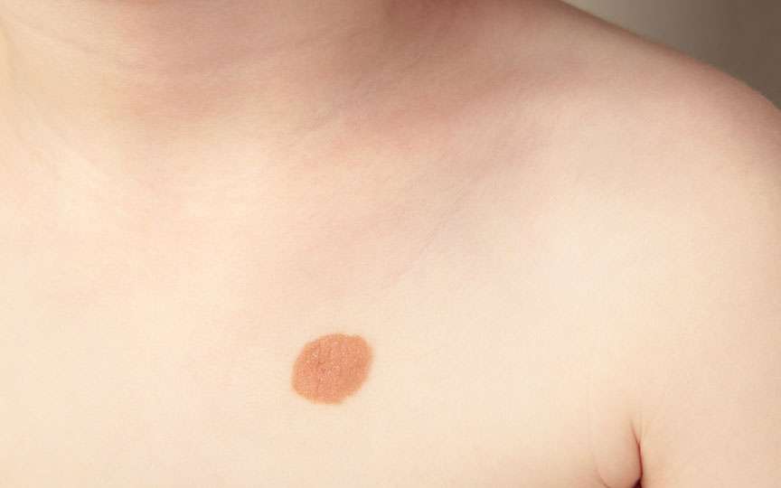 Semnele din naștere la copii – tipuri, cauze și îngrijire