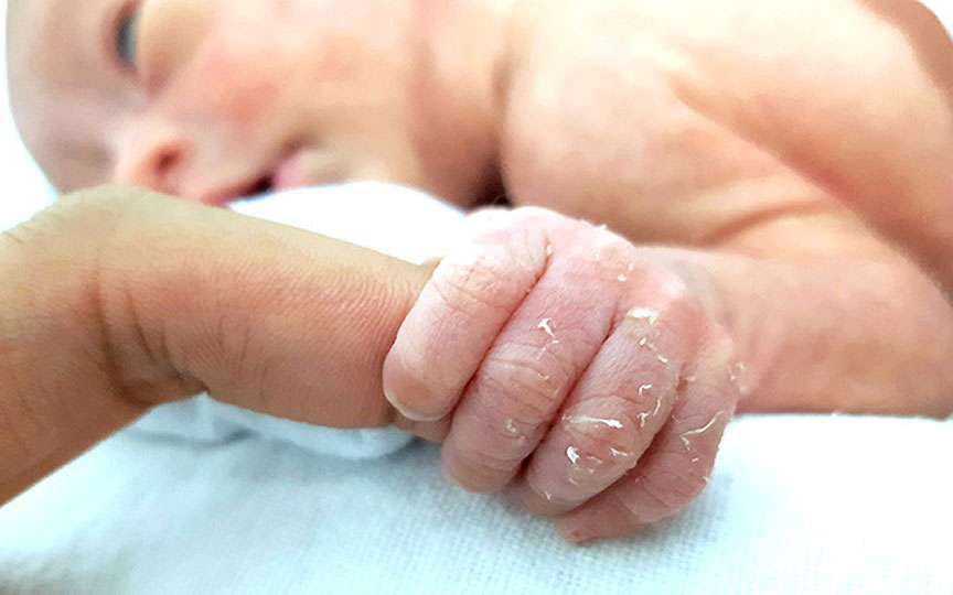 De ce se decojește pielea copiilor pe degete și când trebuie mers la medic
