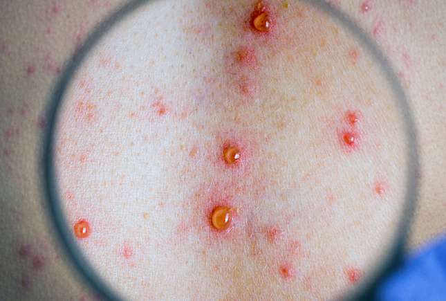 Varicela la copii: simptome, tratament și prevenție corectă