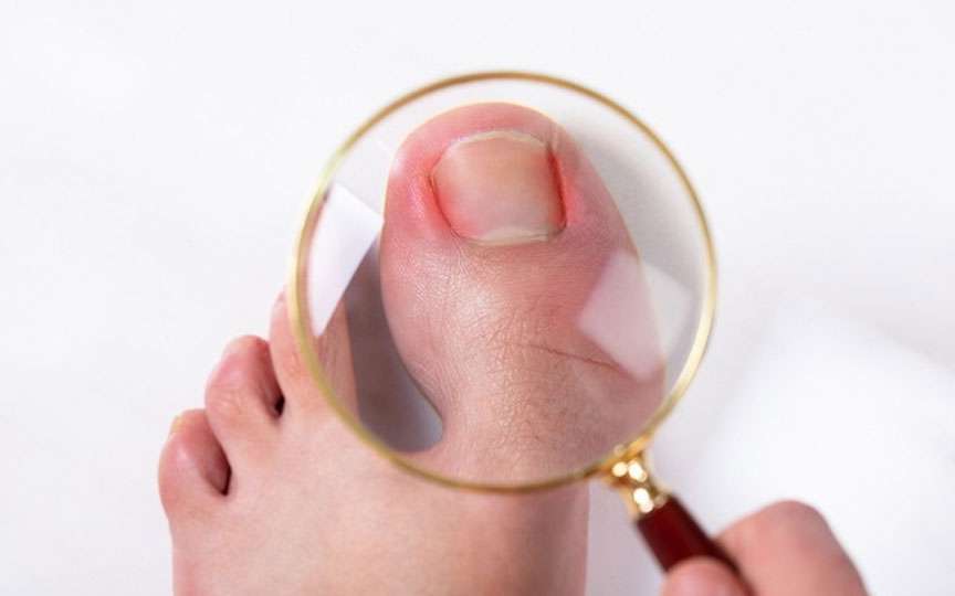 Unghia încarnată: cauze, simptome, tratament și prevenție