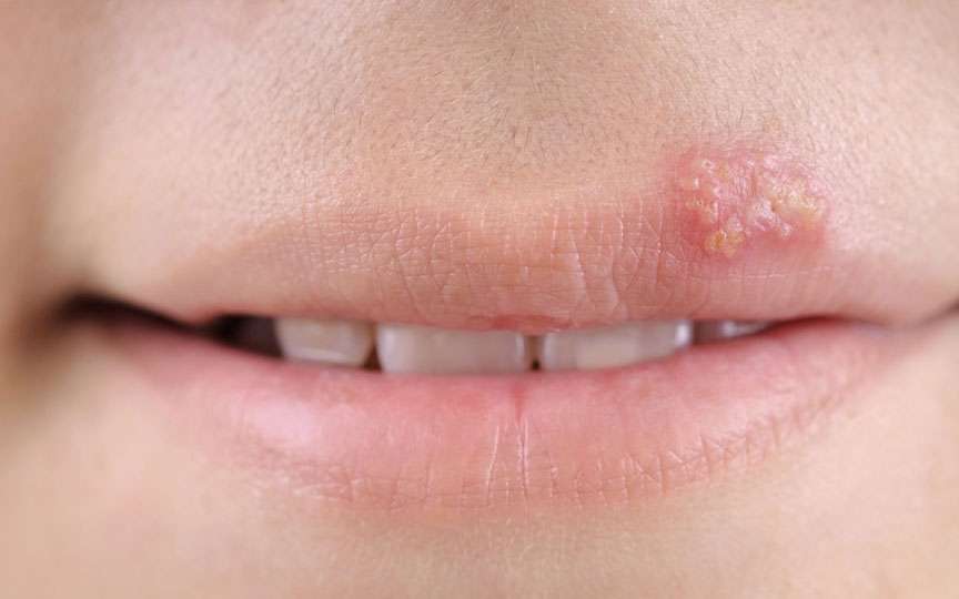 Herpes pe buze: cauze, tratament și prevenție