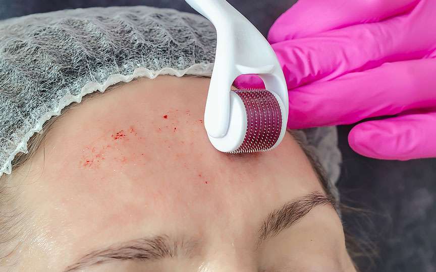 Cele mai periculoase proceduri cosmetologice făcute acasă: ce riscuri ascund trendurile de pe TikTok