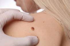 Cancerul de piele în Republica Moldova – date oficiale și recomandări pentru prevenție