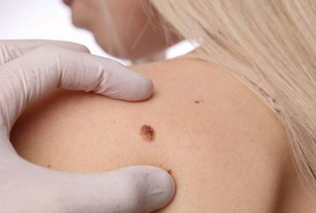 Cancerul de piele în Republica Moldova – date oficiale și recomandări pentru prevenție
