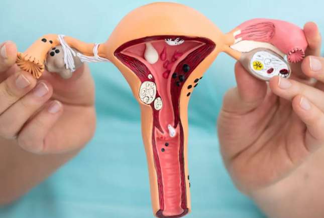 Endometrioza: ce este, cum se tratează și ce trebuie să știe fiecare femeie