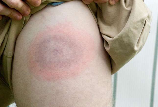 Boala Lyme și toxiinfecții alimentare în creștere la Chișinău: ce arată datele recente