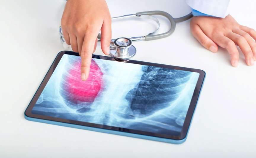 Screening pulmonar gratuit în raionul Ialoveni: program și localități disponibile între 29 iunie și 3 iulie